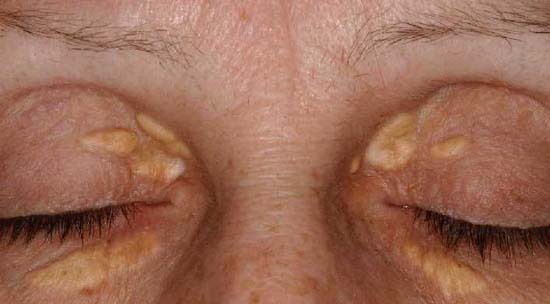 Xanthelasma