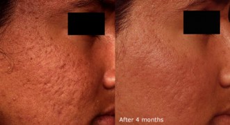 acne treatment dubai