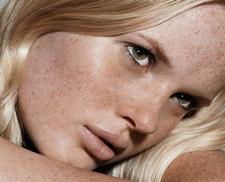 freckles removal in dubai