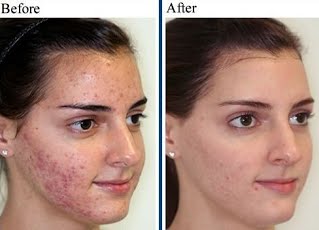 scar removal dubai