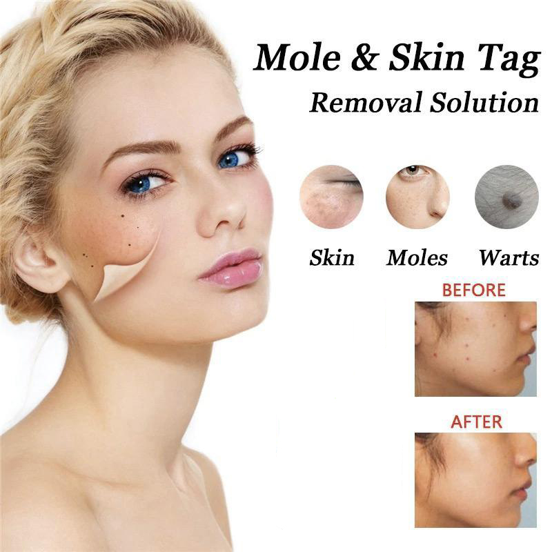 skin tag removal in dubai