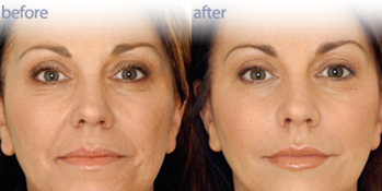 Wrinkle Removal Dubai